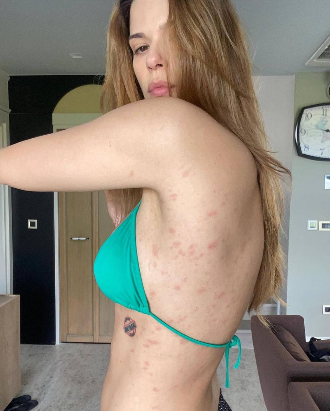 Vücudunu göstererek yakalandığı hastalığı paylaştı! Takipçileri kahroldu... 6